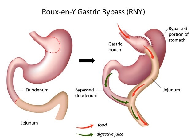 Roux-en-Y Gastric Bypass (RNY) diagram
